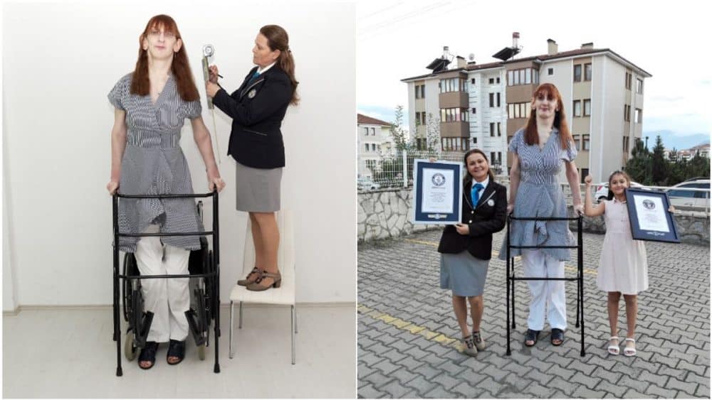 Rumeysa Gelgi: conheça a mulher mais alta do mundo e entenda a síndrome de Weaver