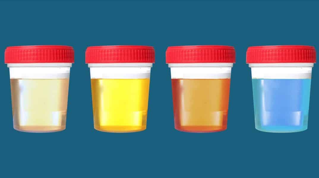Quais as cores da urina e o que revelam sobre a sua saúde?